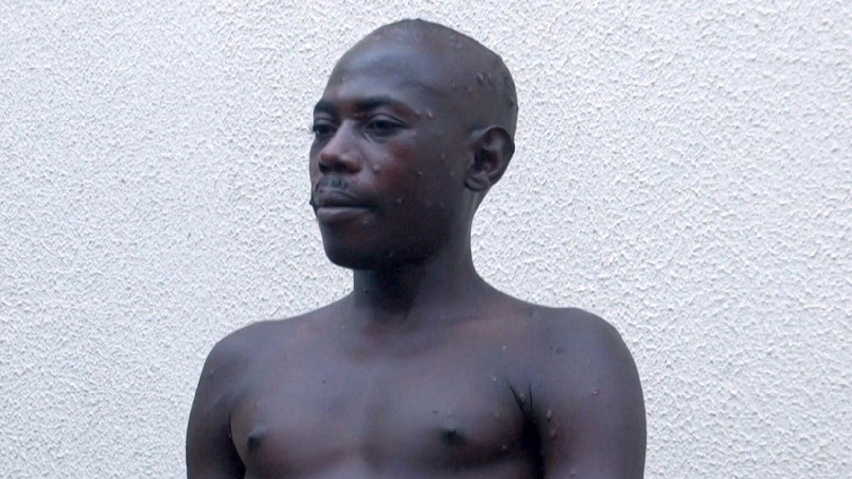 Samuel Nduwimana, mpox, cacar monyet 