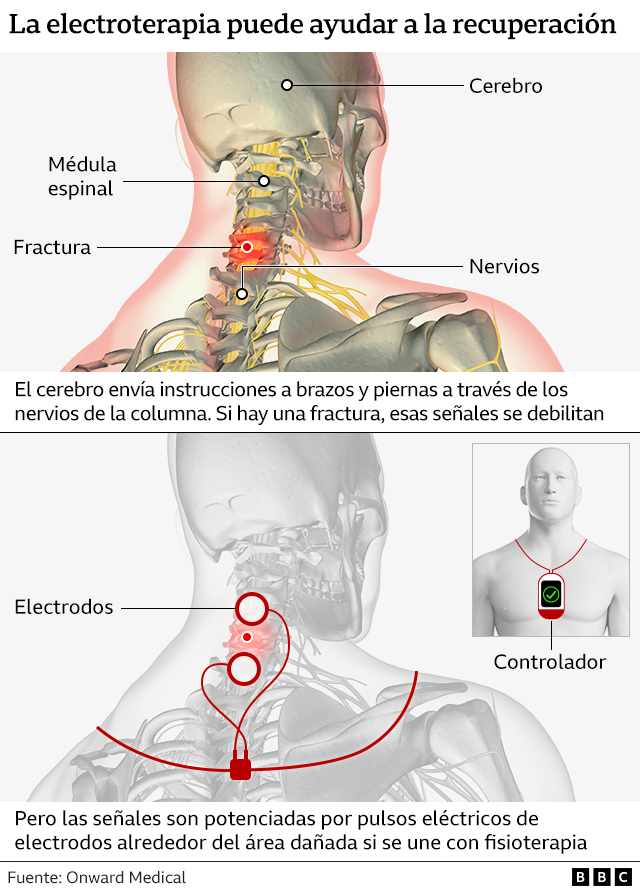 Infografía que muestra cómo la electroterapia puede ayudar a la recuperación