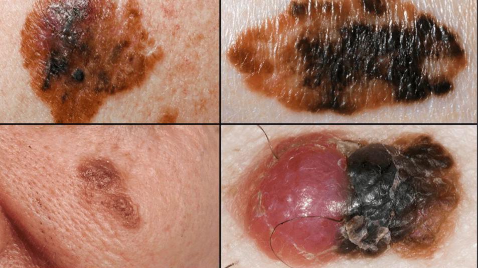 Muestras de piel con posible melanoma