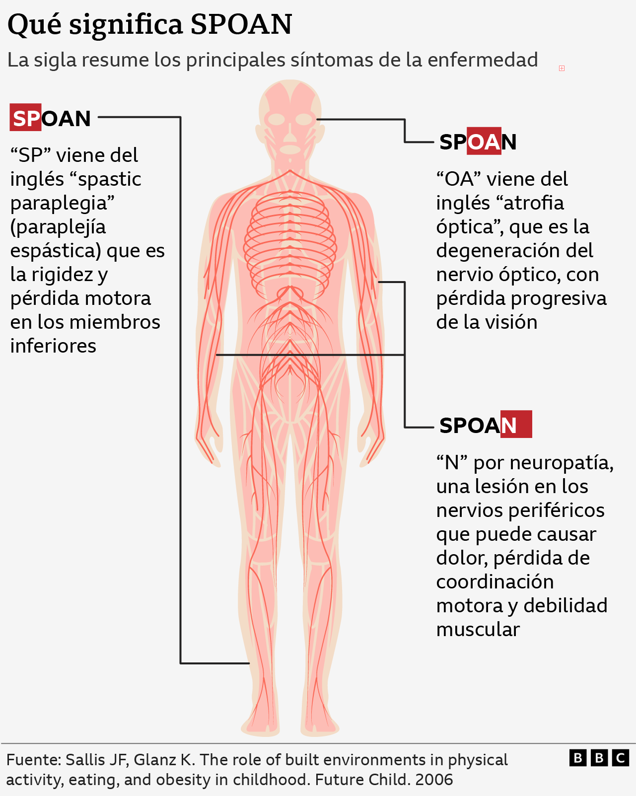 Infografía que explica los síntomas del síndrome Spoan.