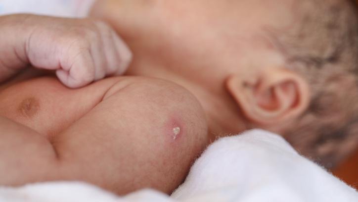 Bebê com marca no braço de vacina recém-aplicada