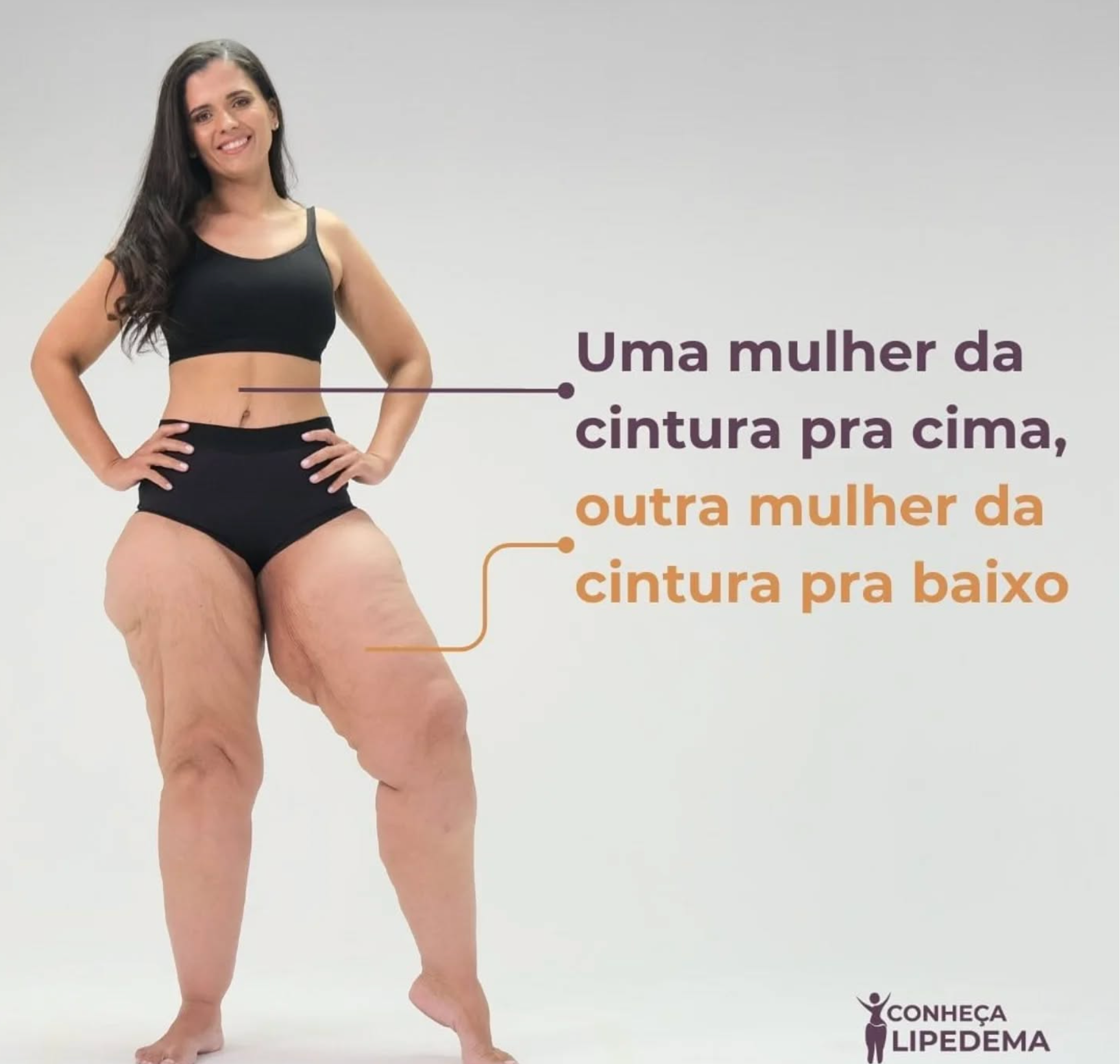 Paciente mostra a diferença causada pelo lipedema no formato de seu corpo em foto de campanha de conscientização da doença feita pela ONG Movimento Lipedema