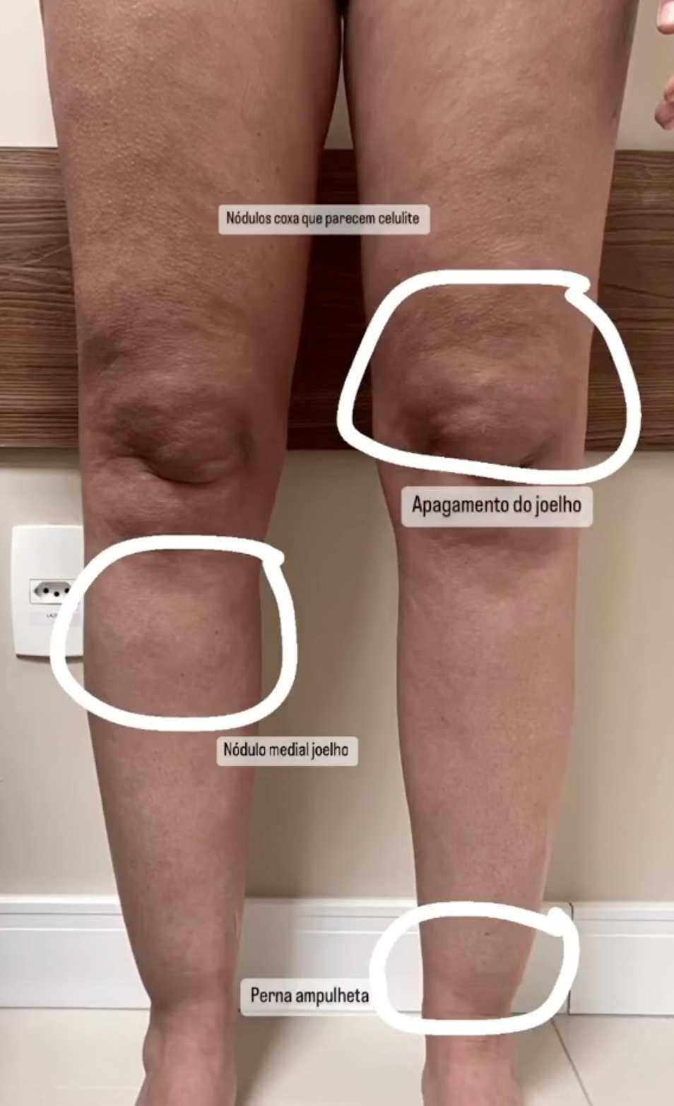 Um vídeo publicado pela médica Thais Torres, cirurgiã vascular, mostra alguns sinais visuais específicos do lipedema nas pernas