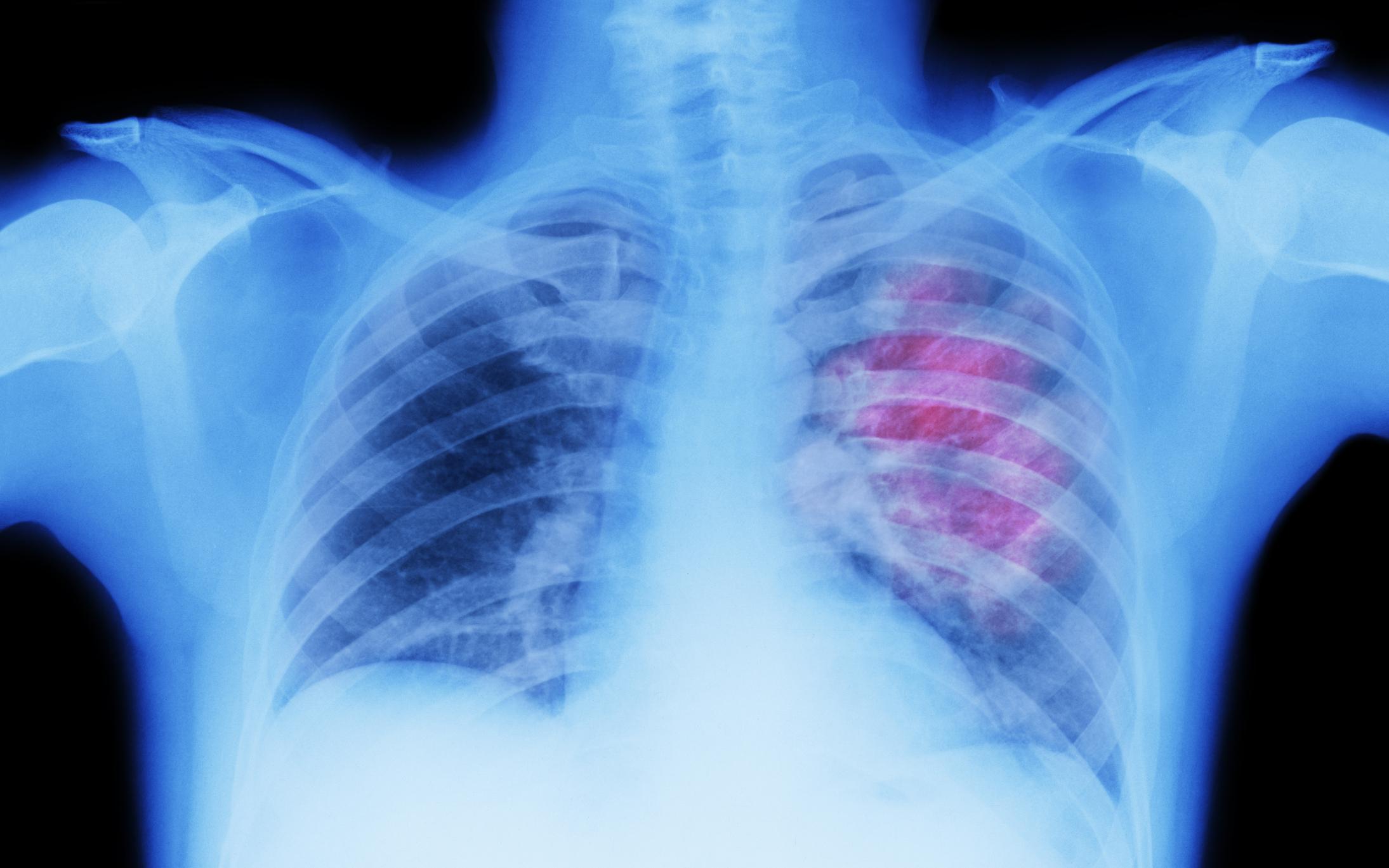 Cáncer de pulmón en un escaneo médico.