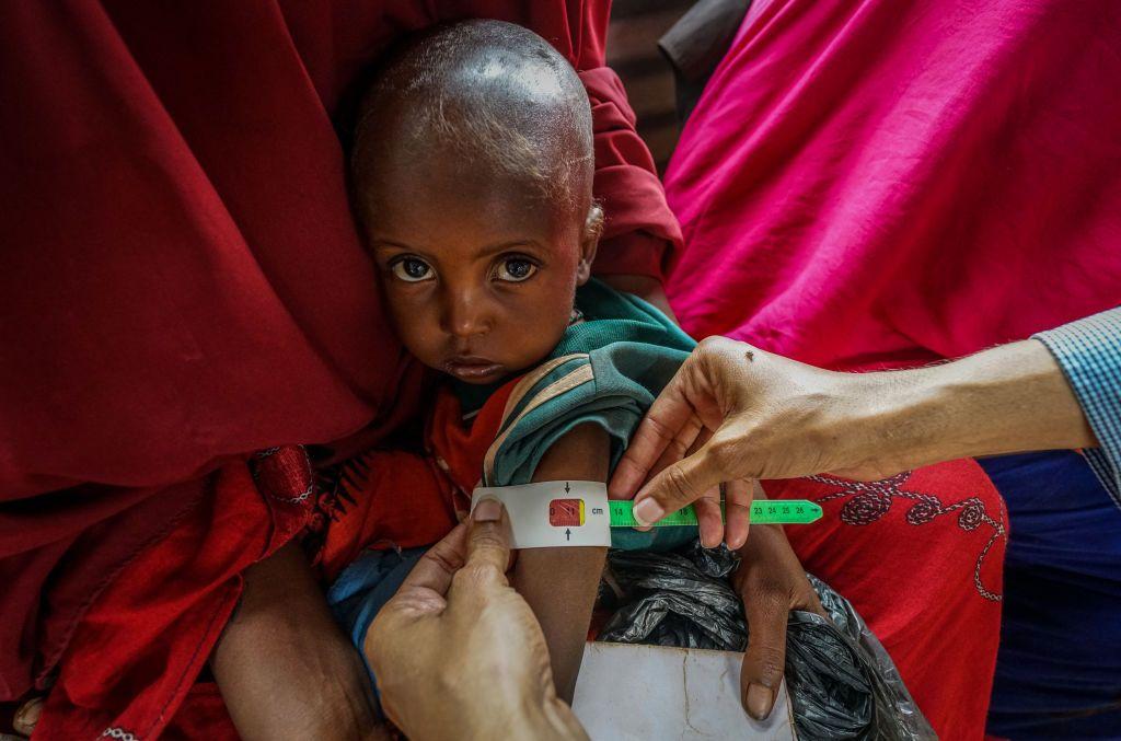 Un niño somalí recibiendo atención médica.