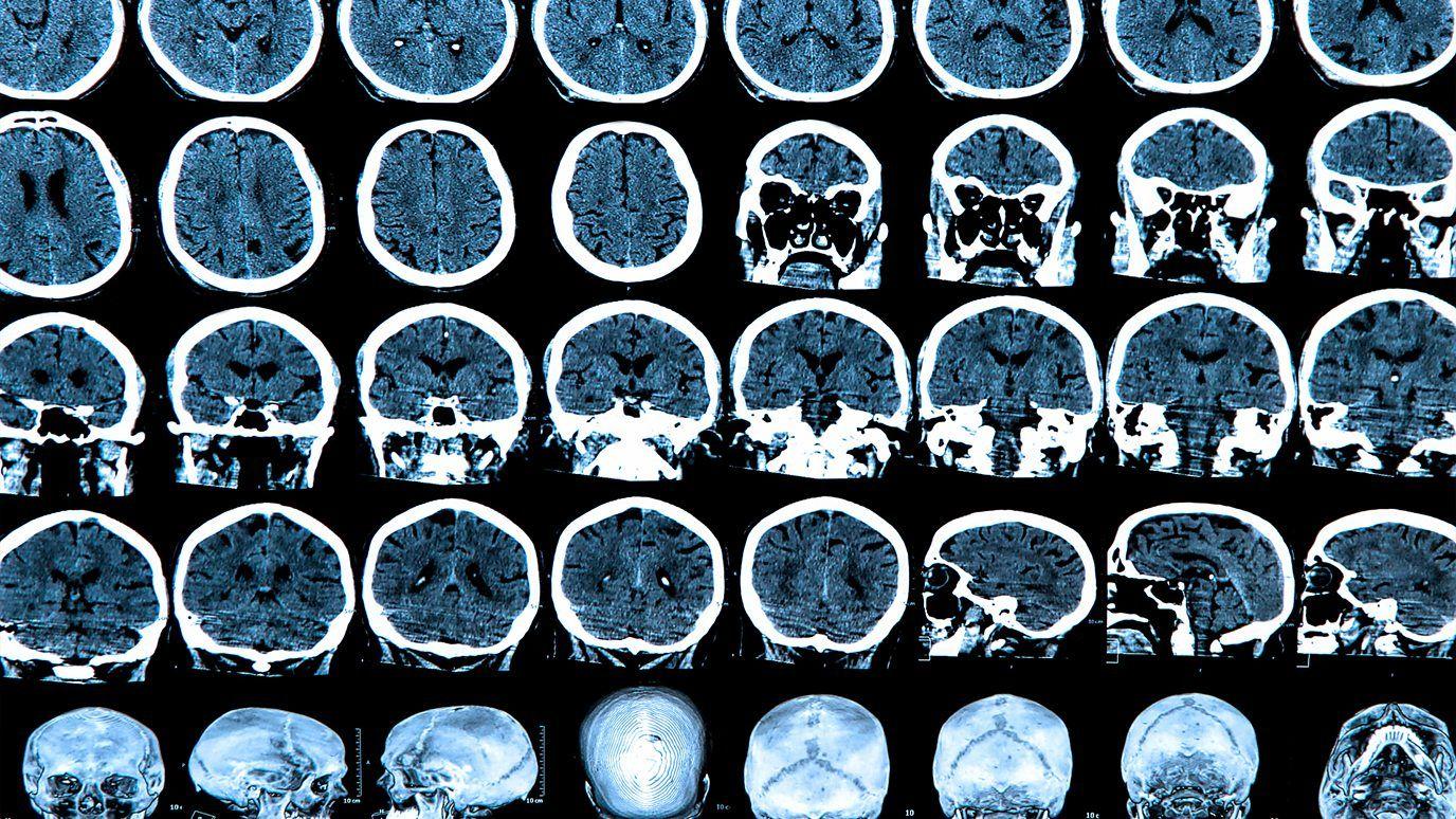 imagen de rayos X de un cerebro humano 