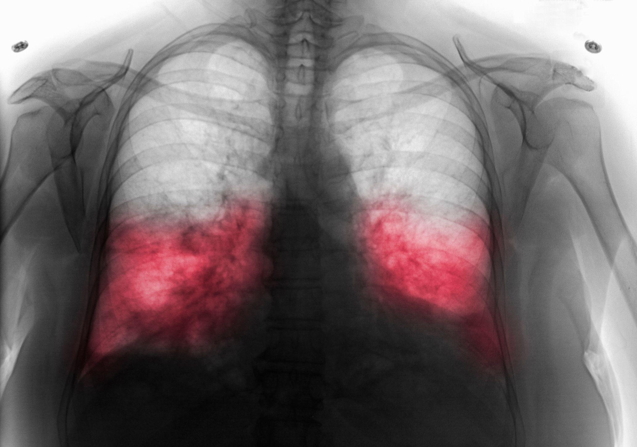 Rendgen snimak osobe sa obostranom upalom pluća
