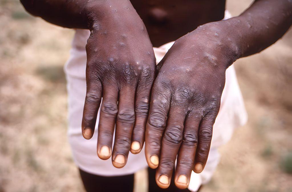 La manos de una persona con mpox llena de erupciones