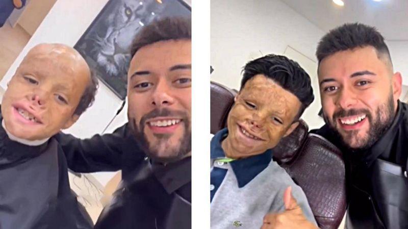 Joao, antes y después de recibir la prótesis capilar, junto a Francisco.