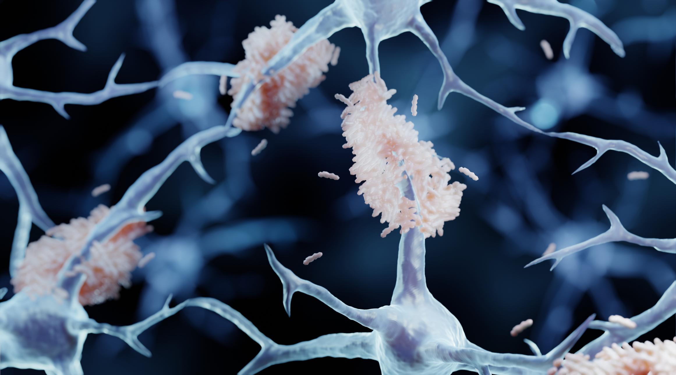 Acúmulo de placas formadas pela proteína beta-amiloide (em rosa) nos neurônios 