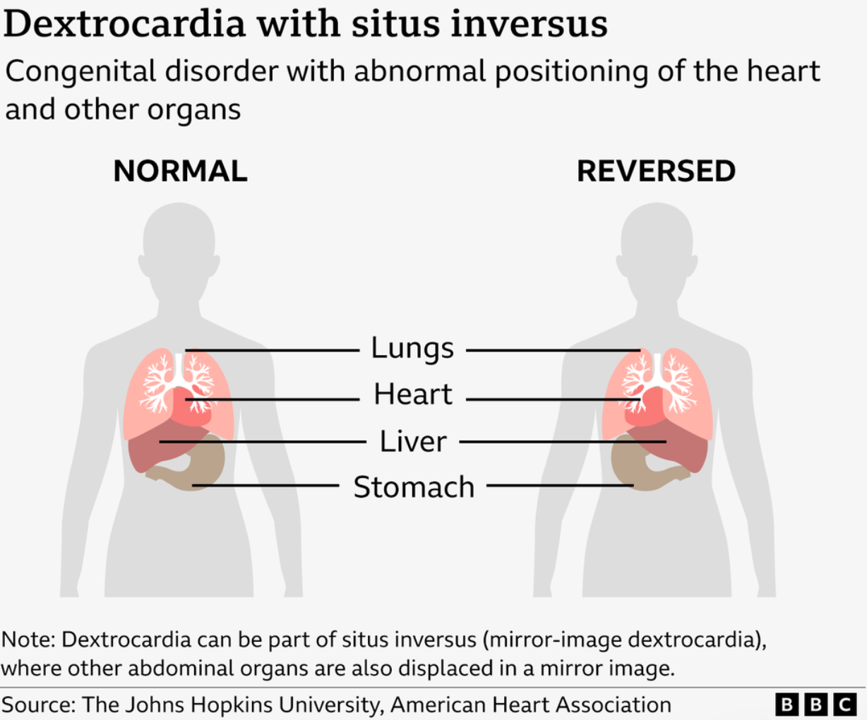 Graphic illustration of congenital disorder with abnormal positioning of the heart and other organs