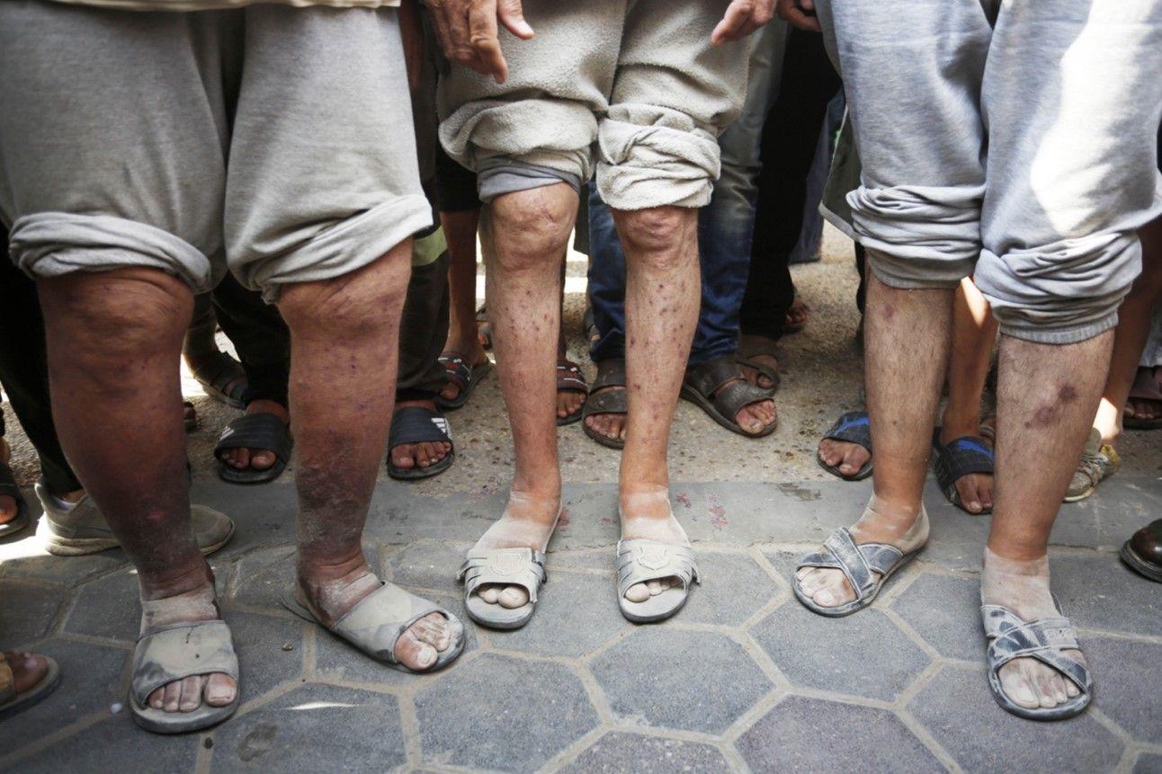 سجناء فلسطينيون من قطاع غزة أفرج عنهم ولديهم ندوب على أجسادهم