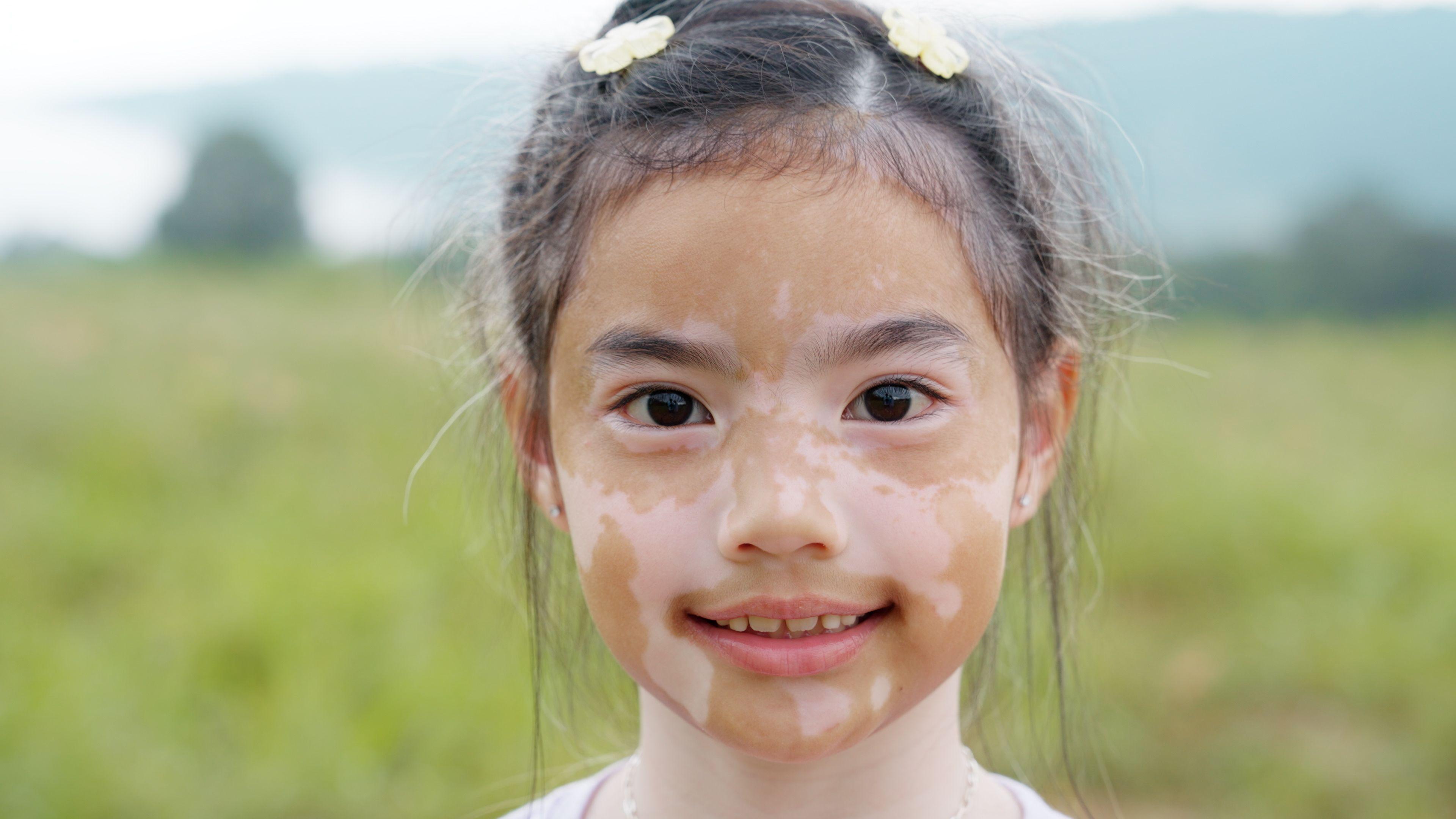 Una niña con vitiligo