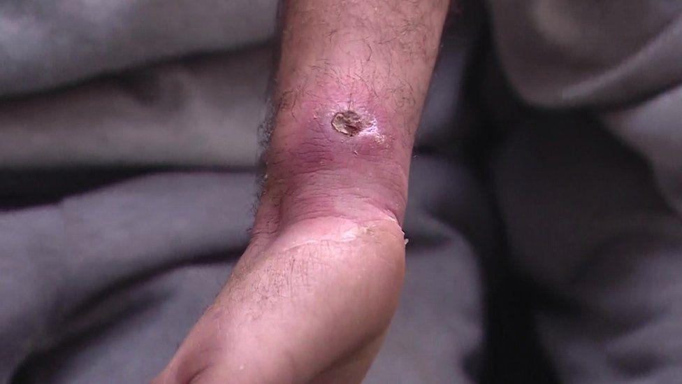 A deep wound and sore on one of the men's wrists