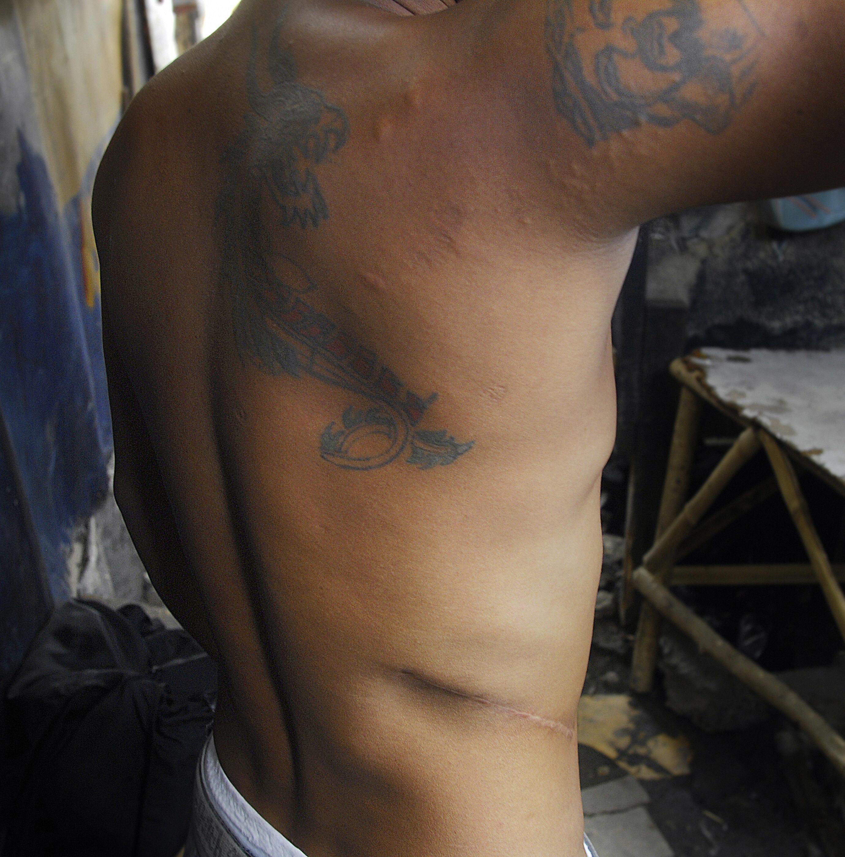Un hombre en Filipinas muestra la cicatriz después de donar un riñón por dinero.