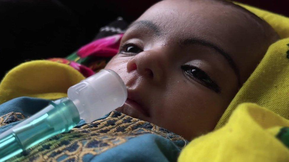 Bebê com tubo de oxigênio no nariz