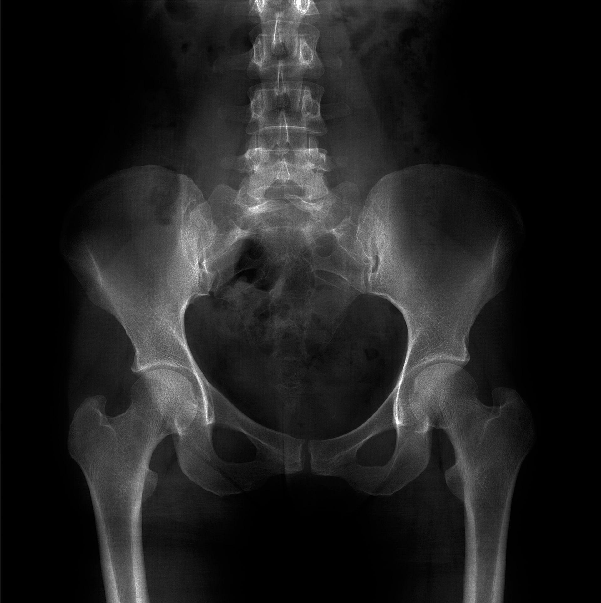 Radiografía de la pelvis y la columna lumbosacra con espina bífida.