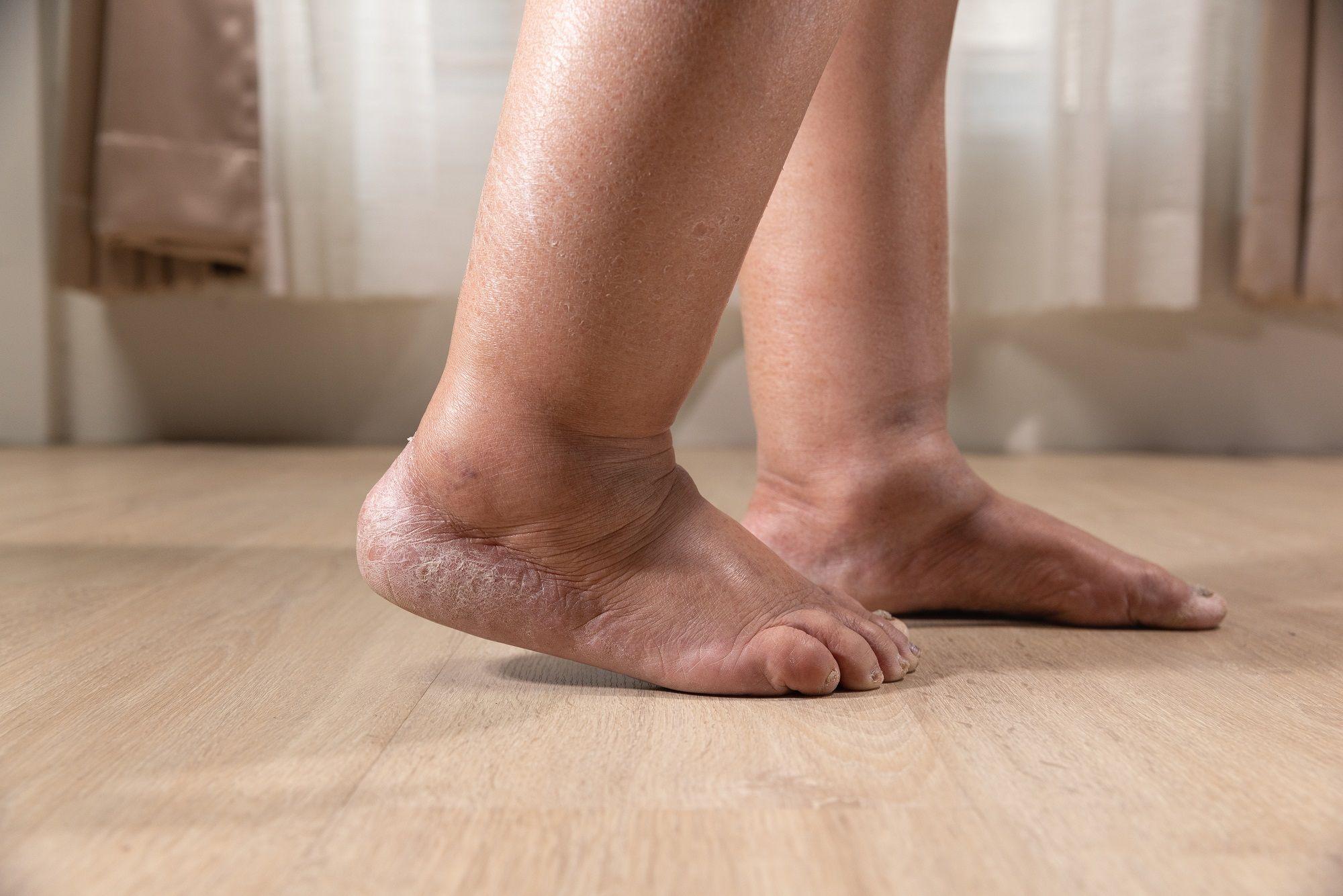 Edema di kaki.