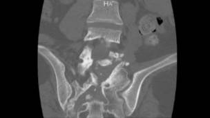 Radiografía de la columna de Muhammad