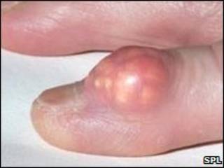 Bệnh gout