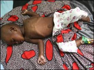 Criança sofre de subnutrição em hospital de Mogadíscio