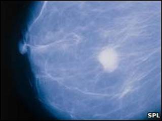 Tumor de mama