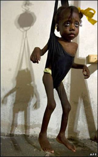 Criança desnutrida no Haiti