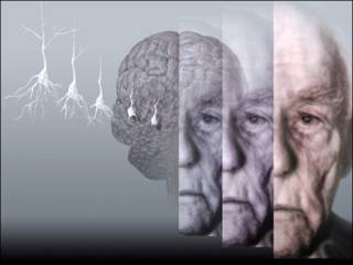 Alzheimer