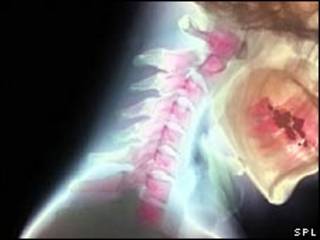 Lesión medular