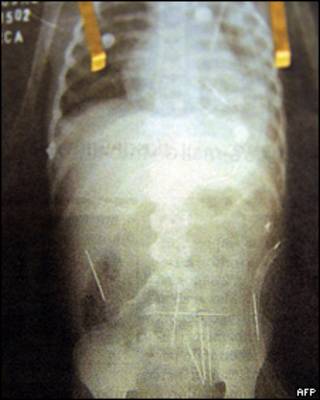 Imagen de rayos X que muestran las agujas en el cuerpo del niño