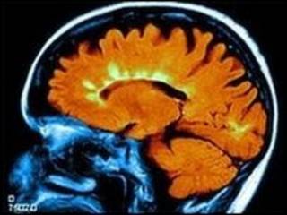 صورة مقطعية لمخ مريض بالتصلب المتعدد