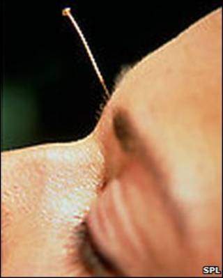 Acupuntura