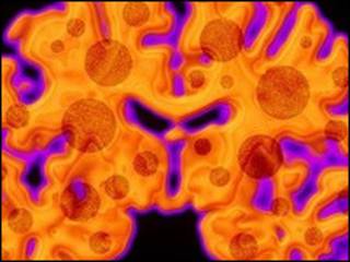 Imagem de cérebro com Mal de Alzheimer