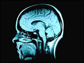 Alzheimer