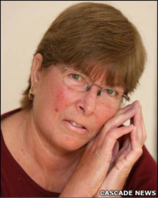 Susan Johnson, que sofre de esclerodermia