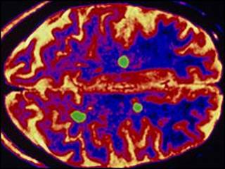 Escáner de cerebro con EM (SPL)