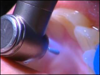 Broca de dentista. Foto: BBC
