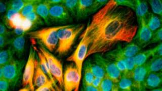 Células de melanoma