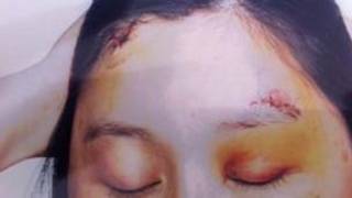 Chinesa mostra marcas da violênc ia/BBC