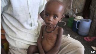 Wani yaro dake fama da rashin abinci mai gina jiki a Somalia