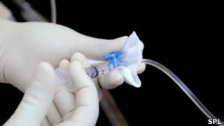 Tratamento de quimioterapia.