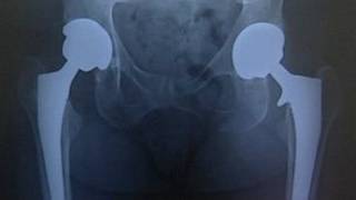 Radiografía de una prótesis de cadera