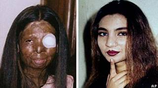 Fakhra Younus antes e depois do ataque com ácido (AFP/Acervo da Família Younus)