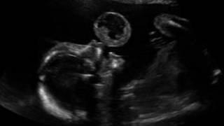 tumour foetus