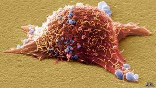Melanoma