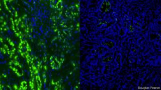Células cancerígenas do pâncreas antes e depois | Foto: Douglas Fearon / Universidade de Cambridge
