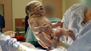 Bebê nascido por cesariana (BBC)
