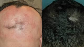 Alopecia | Crédito: PA