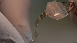 Implant