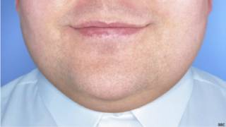 Double chin jab